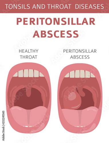 Tonsils and throat diseases. Peritonsillar abscess symptoms, treatment icon set. Medical infographic design photo