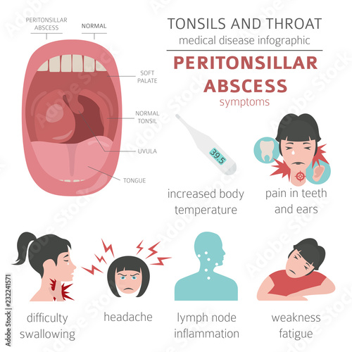 Tonsils and throat diseases. Peritonsillar abscess symptoms, treatment icon set. Medical infographic design