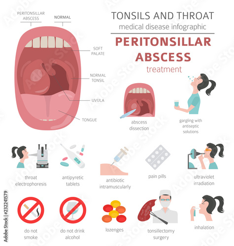 Tonsils and throat diseases. Peritonsillar abscess symptoms, treatment icon set. Medical infographic design