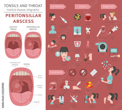 Tonsils and throat diseases. Peritonsillar abscess symptoms, treatment icon set. Medical infographic design