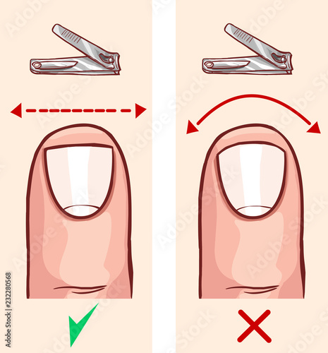 Correct and incorrect fingernail cut