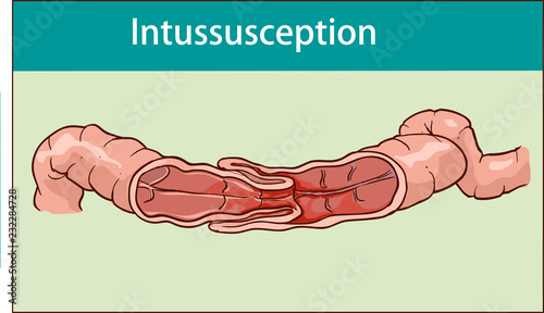 vector illustration of intussusception of intestine. obstruction.