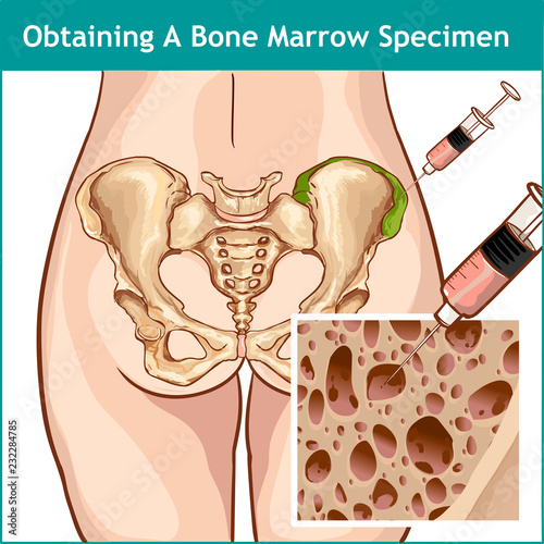  VECTOR İLLUSTRATİON OF A BONE MARROW ASPIRATION