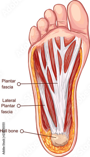 Vector illustration of a Plantar fascitis illustration