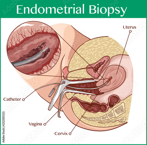 Cross section biomedical illustration of endometrial biopsy