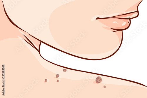 Vector illustration of a Skin Tag Removal Methods