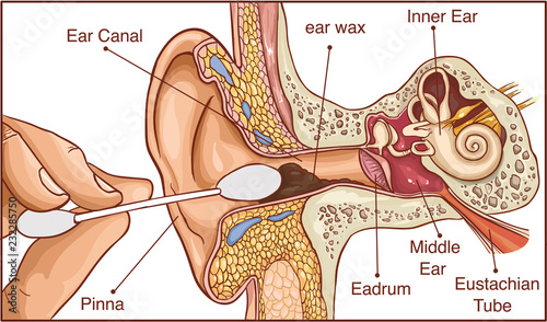 Section of the ear with the earwax - colorful diagram