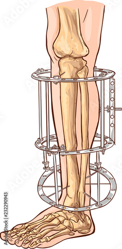 Vector illustration of aExternal ring fixator technique in orthopedic medicine