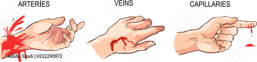 vector illustration of a  Arterial and venous bleeding photo