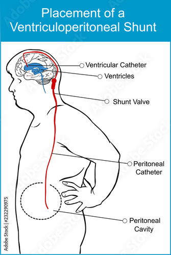 Vector illustration of a placement of a Ventriculoperitoneal shunt