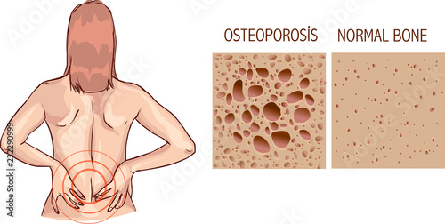 Osteoporosis, human bone anatomy. Medical illustration healthy bone and unhealthy bone