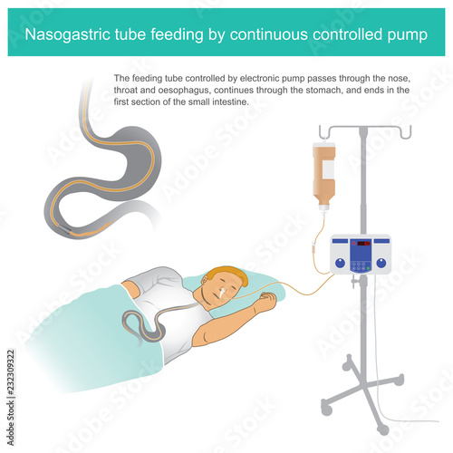 Nasogastric tube feeding by continuous controlled pump. The feeding tube controlled by electronic pump passes through the nose