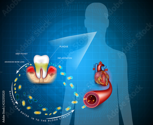 Fototapeta Naklejka Na Ścianę i Meble -  Gum disease inflammation bacteria can enter in to the blood stream an affect heart.  Periodontitis disease disease anatomy on an abstract blue background