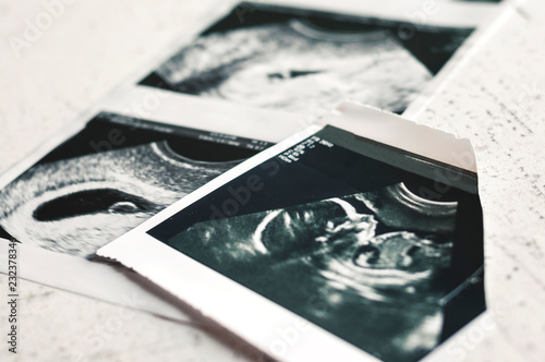 Photographs of ultrasound of pregnancy at 4 weeks and 20 weeks of pregnancy. Selective focus
