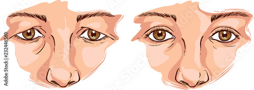  white background Vector illustration of a eyelid lift