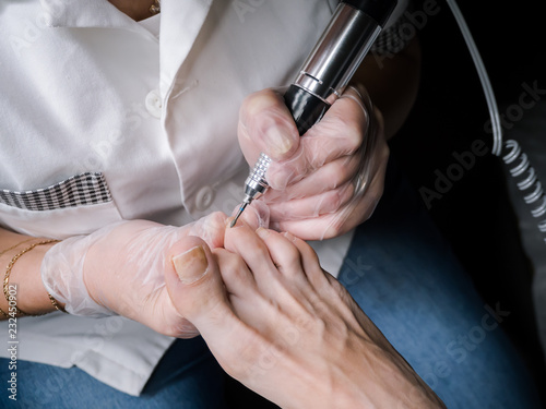 Treatment of the cuticle cutter on the nails of the feet.
