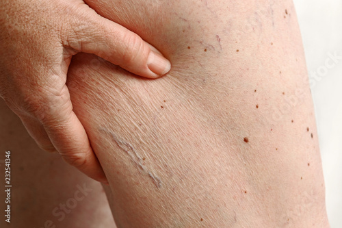 Besenreiser und Cellulite am Bein einer Frau photo