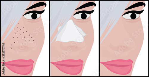 Blackheads on Nose