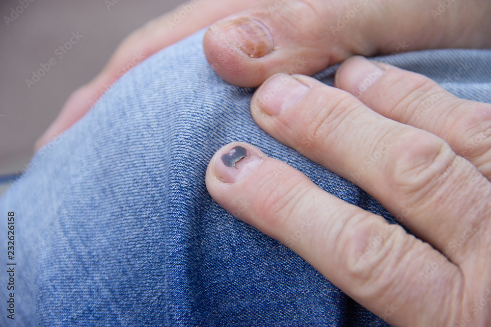 Black nail. Hammer on the thumb. Pain and hematoma after injury. Male