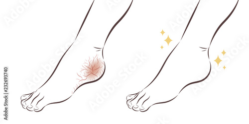 Feet with dry skin