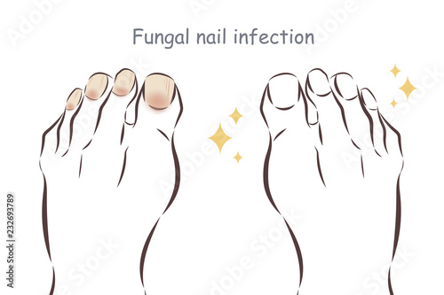 feet with fungal nail infection