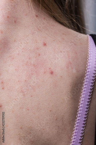 woman with skin problem acne on back