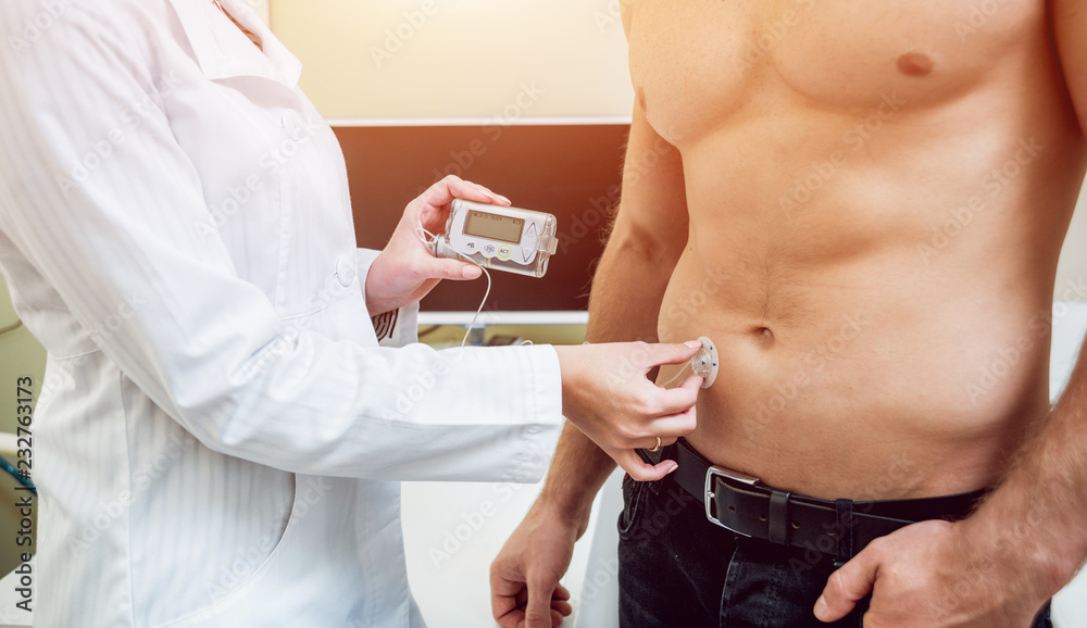 Doctor with an insulin pump connected in patient abdomen and holding the insulin pump at his hands.