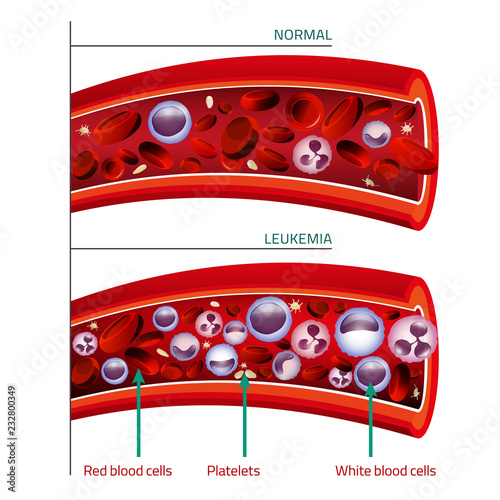 Leukemia Infographic Image