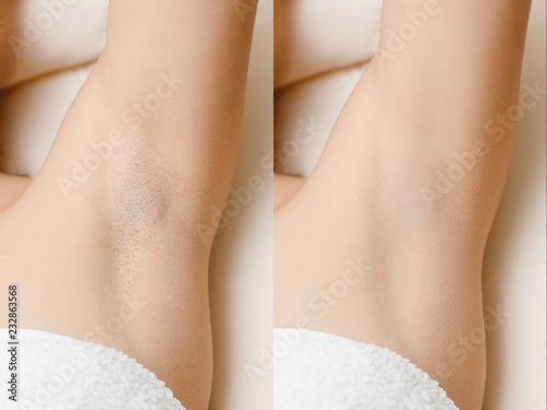 Women underarm hair removal before and after