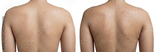 Young Asian woman have acne with red spots on the back and clean back isolated on white background, with clipping path, before and after.