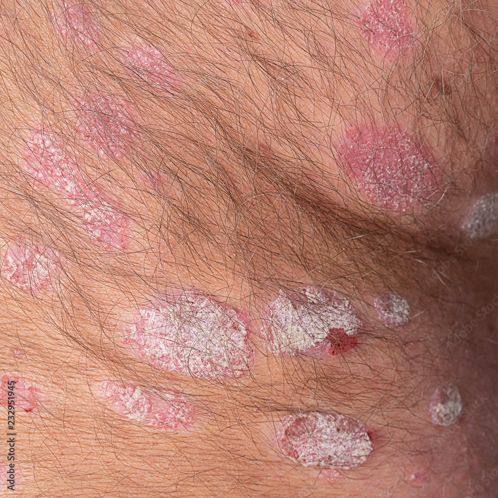 Fototapeta premium Psoriasis on the human body, close-up