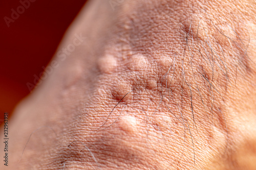 The lesion on foot after caused by ants bites (Red imported fire ant).