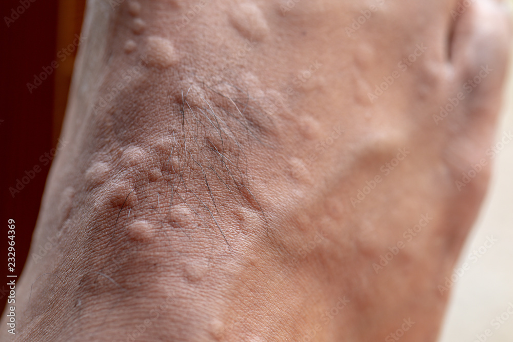 The lesion on foot after caused by ants bites (Red imported fire ant). The lesion on foot after caused by ants bites (Red imported fire ant).