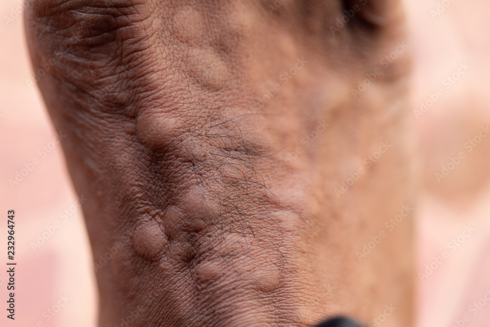 The lesion on foot after caused by ants bites (Red imported fire ant). The lesion on foot after caused by ants bites (Red imported fire ant).