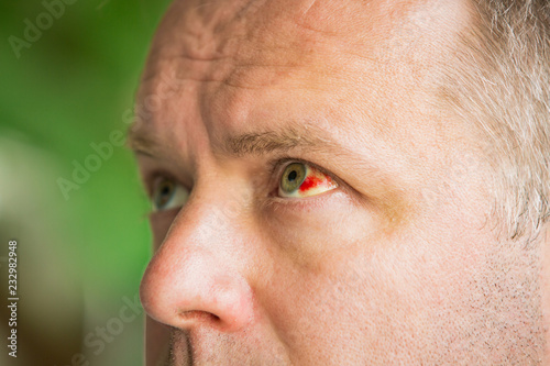 Close up of man with broken blood vessel in eye. Subconjunctival bleeding photo
