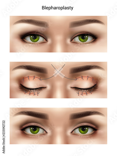 Blepharoplasty Suture Stitches Composition