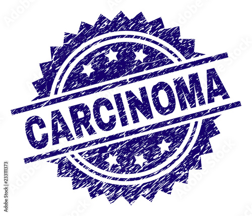 CARCINOMA stamp seal watermark with distress style. Blue vector rubber print of CARCINOMA caption with retro texture.