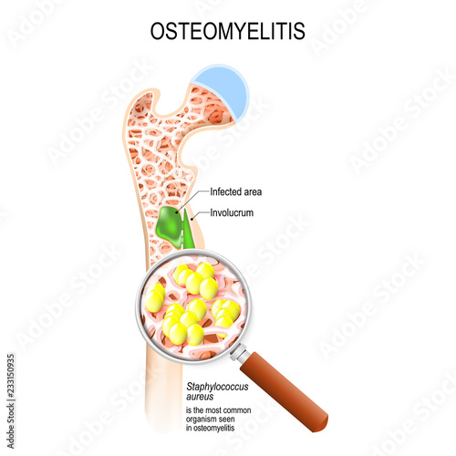 Osteomyelitis and bacterial infection that caused this disease photo