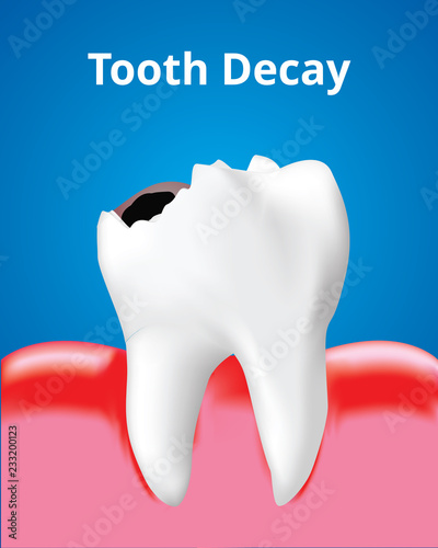 Tooth Decay with Inflamed gum, Dental care concept, Realistic design illustration Vector.