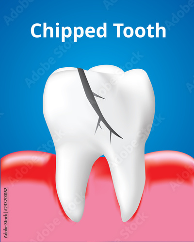 Chipped tooth with Inflamed gum, Dental care concept, Realistic design illustration Vector.