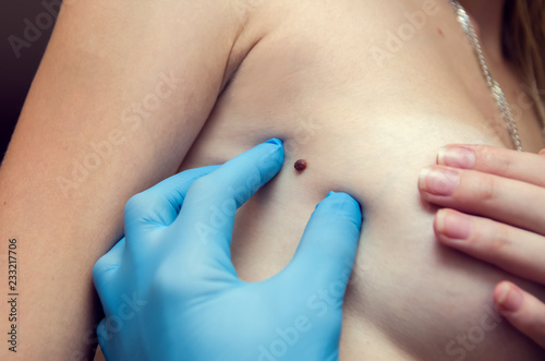 doctor examining female patient in clinic. Cancer awareness. Birthmark on the chest
