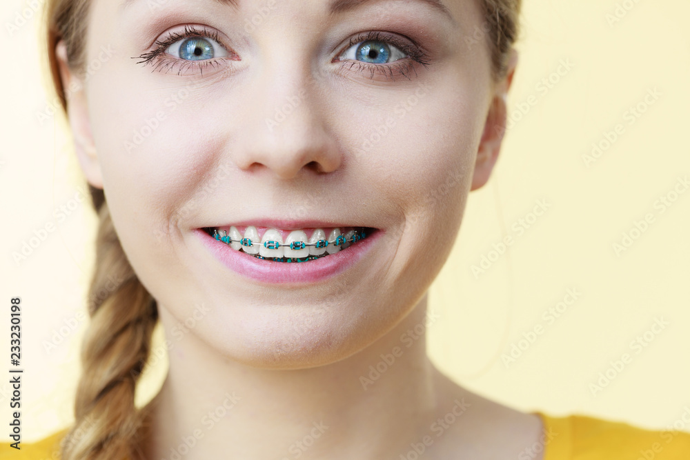 Young woman showing teeth braces Young woman showing teeth braces