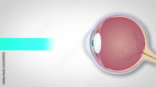 Schematic representation of hyperopia, myopia and astigmatism, Correction of various eye vision disorders by lens. Hyperopia, myopia and astigmatism