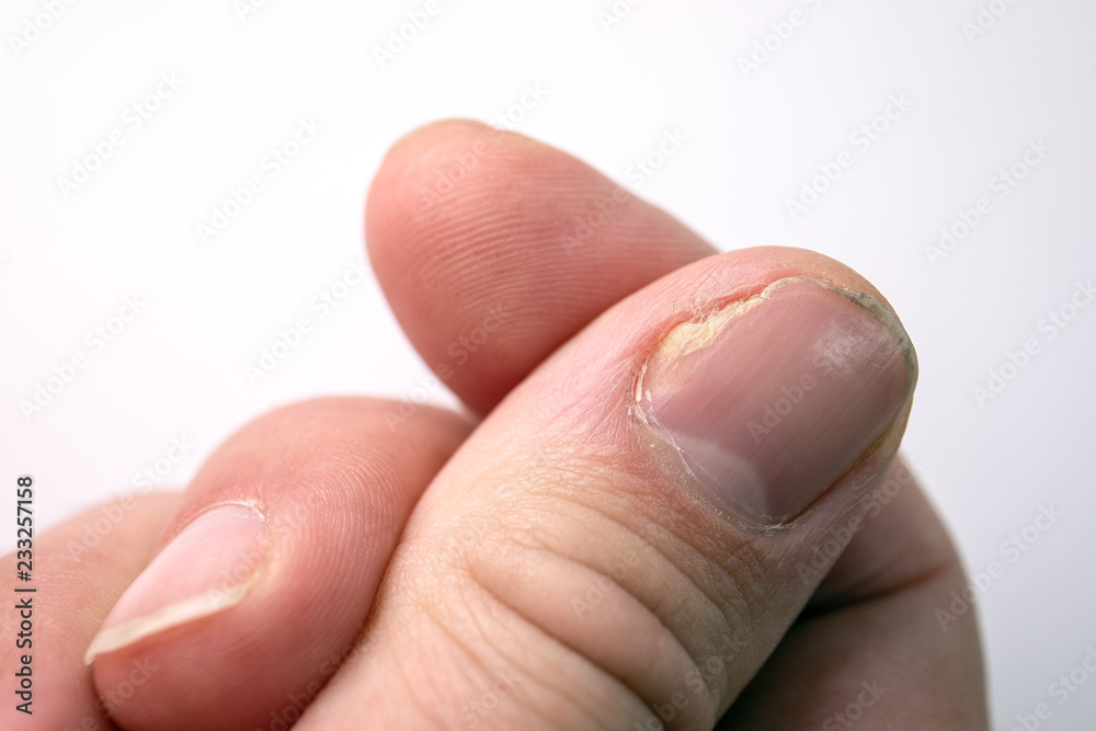 fingernail infection . on accutane : r/Accutane