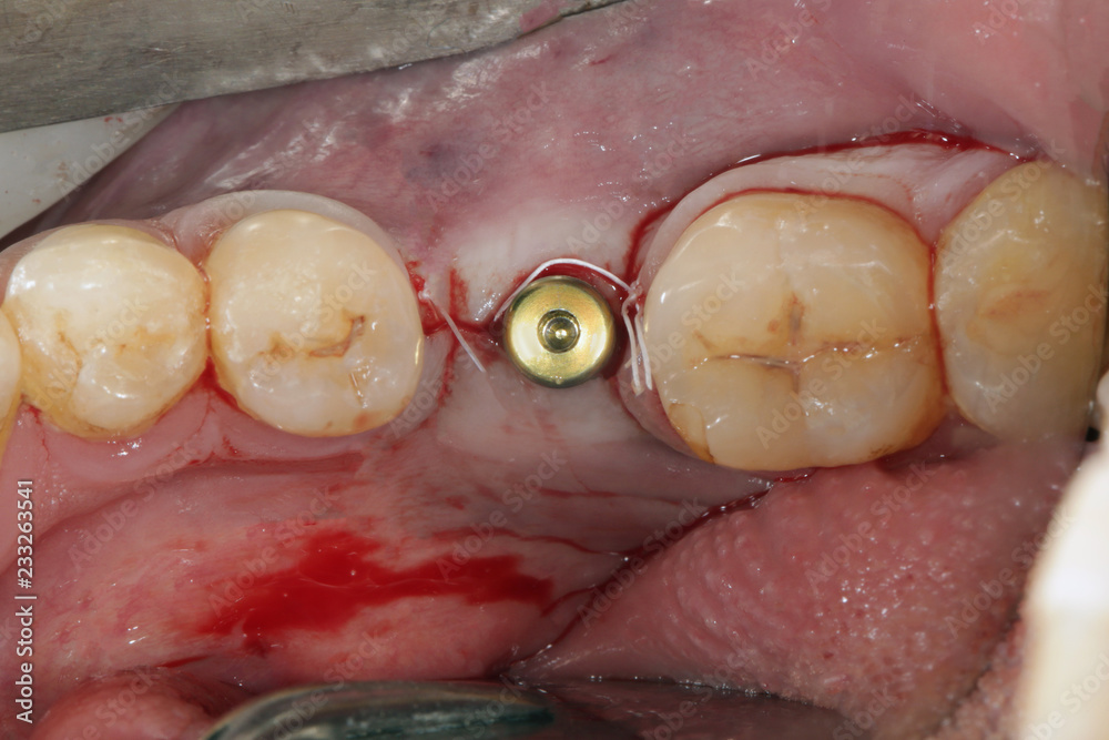 Obraz premium plug after imlantirovaniya Dental chewing on parts
