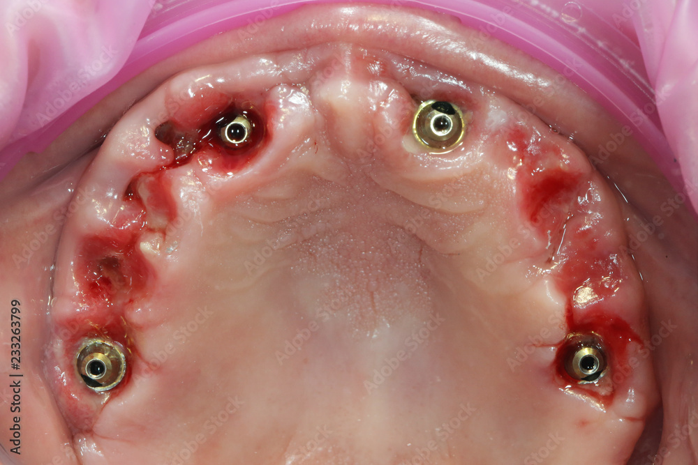 Fototapeta premium reduction of the crest and buildup of soft tissue with artificial membranes