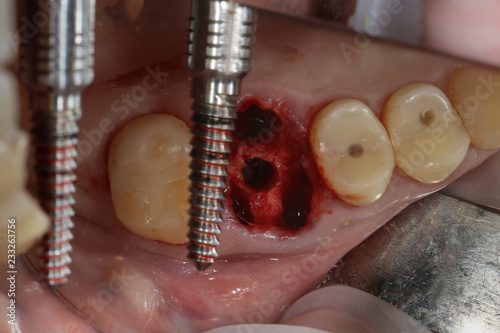 Long Dental drill for implantation photo