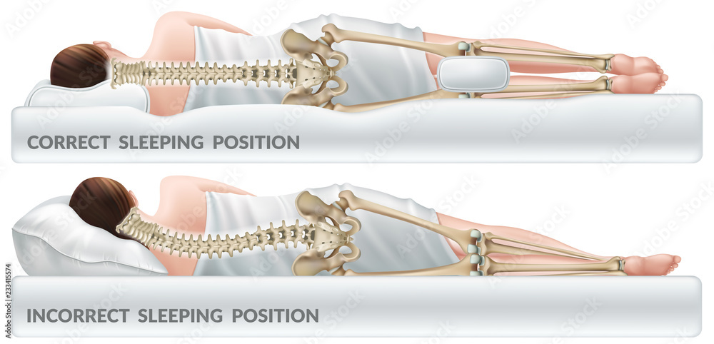 Orthopedic pillow for knees. Correct and incorrect sleeping position legs. Isolated 3d realistic vector illustration. - obrazy, fototapety, plakaty 