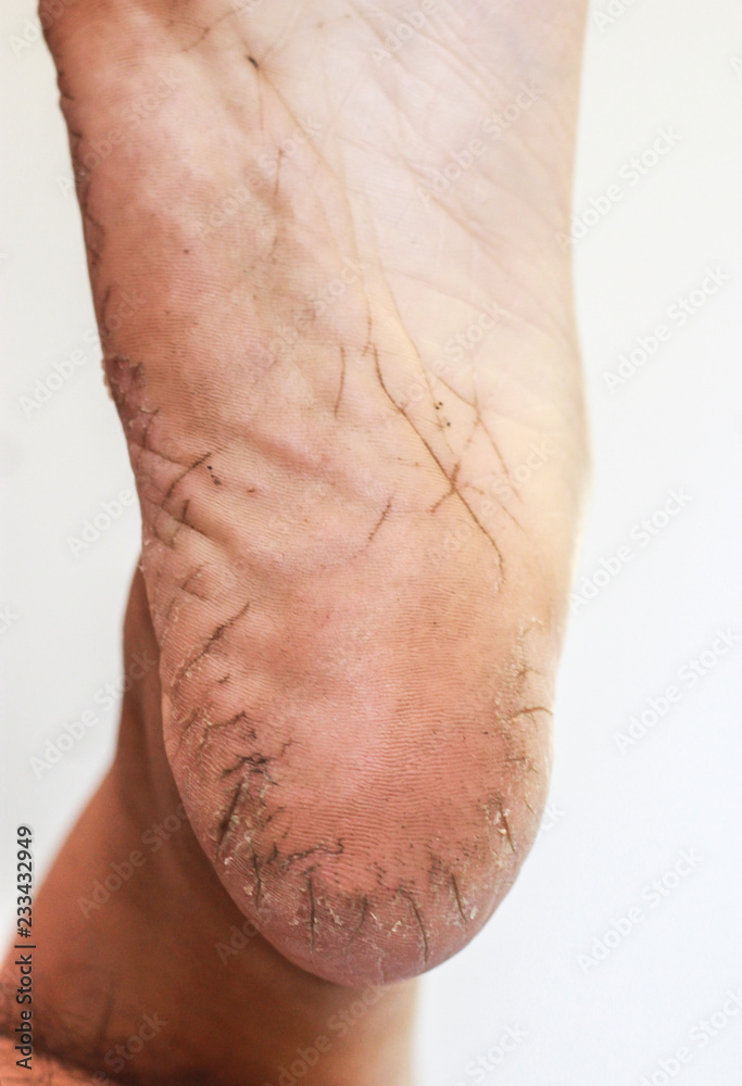 Naklejka premium Broken foot skin