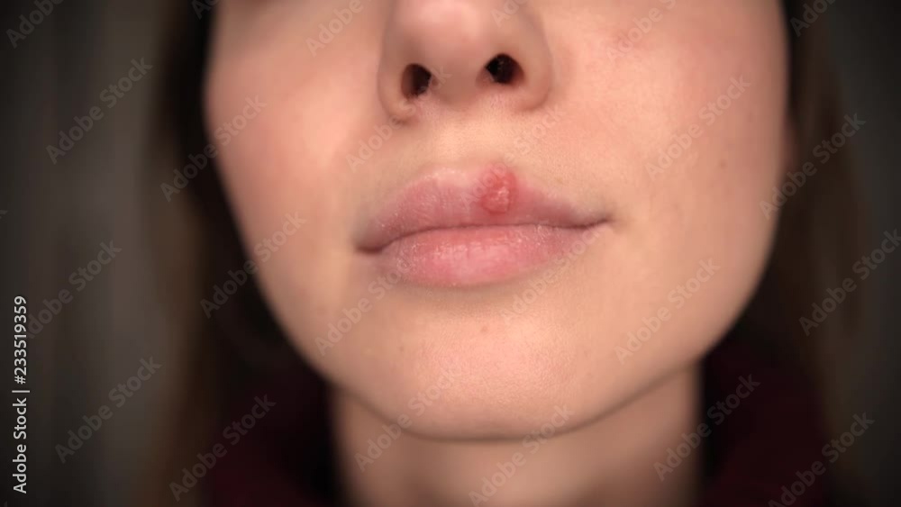 Herpes on the girl's lips Herpes on the girl's lips